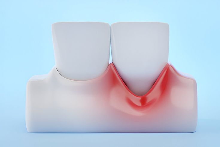 bleeding gum