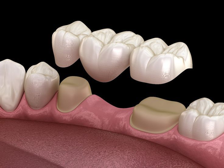 missing tooth