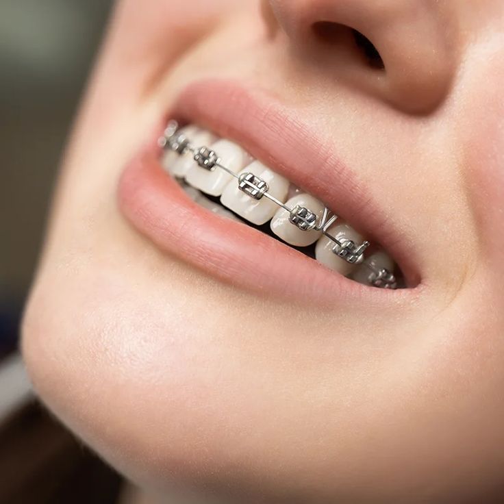 braces treatment