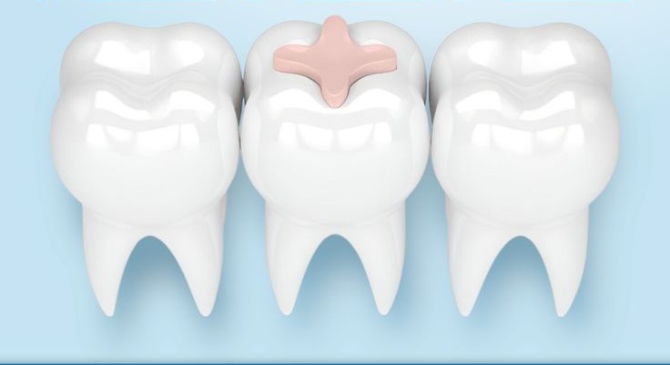 Tooth-Colored Filling: BenefitDentist placing a tooth-colored composite filling on a decayed tooth.s, Procedure & When You Need It