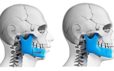 Orthognathic surgery procedure for correcting jaw alignment