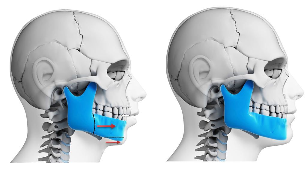 Orthognathic surgery procedure for correcting jaw alignment